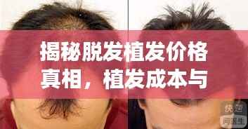 揭秘脱发植发价格真相,植发成本与最佳方案选择全解析